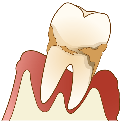 歯周病はどのように進行する?